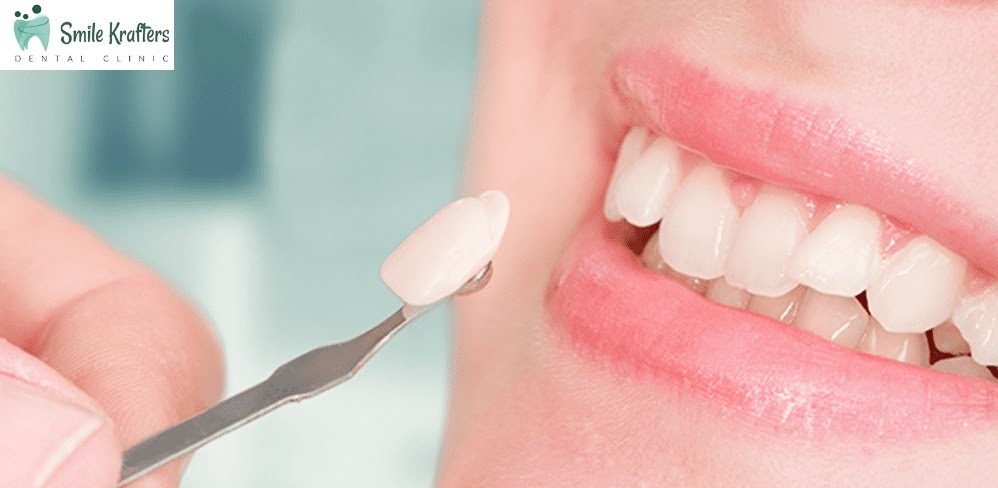 Dental Veneers in Navi Mumbai – Call Experienced Dentists Online