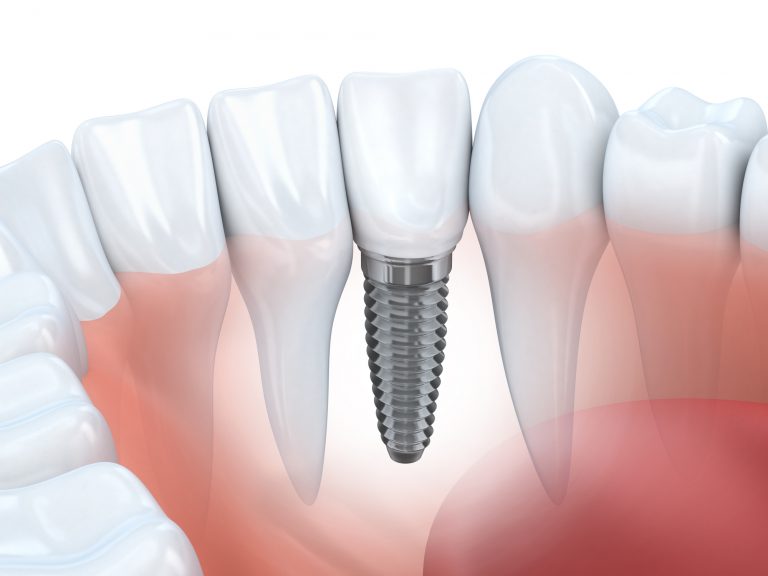 Dental Implants in Juno Beach Fl | 3 Signs It’s Time for Dental Implants - Dr. Kuhl