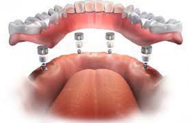 Implant-Supported Dentures: How Can They Enhance Your Daily Life? Article - ArticleTed -  News and Articles