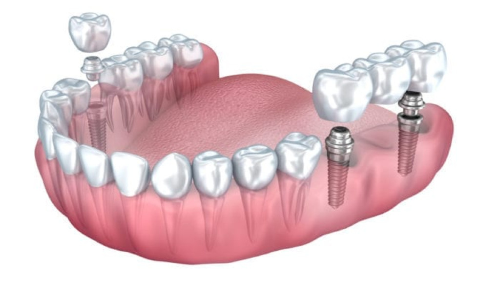 How A Single Tooth Implant Plano Texas Can Restore Your Smile