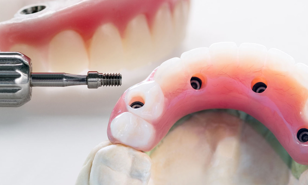 Closing the spaces: How Dental bridges for a complete smile