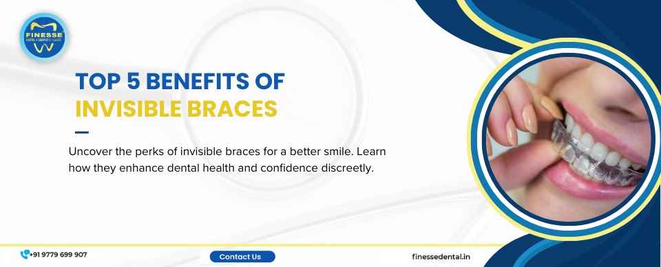 Top 5 Benefits of Invisible Braces