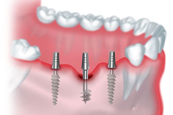 Dental Implants in Coimbatore | Tooth Transplant Cost