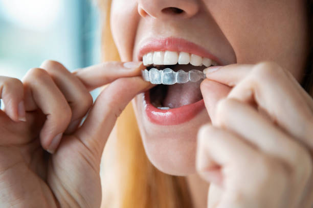 Why Should You Consider Invisalign?: alignortho — LiveJournal
