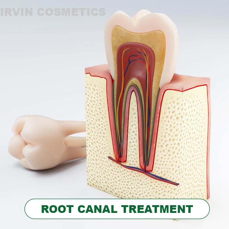 Painless Root Canal Treatment in Gurgaon | Root Canal in Gurgaon