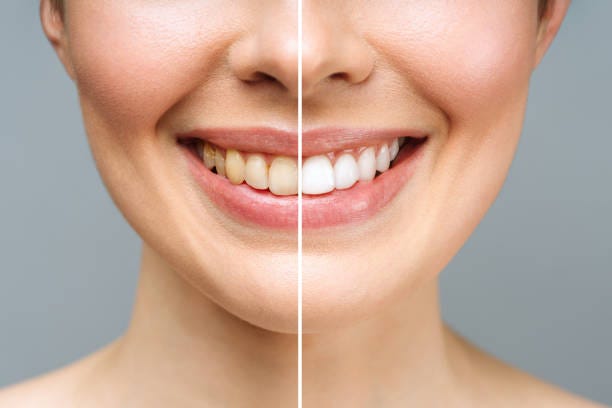 Why People Consider Teeth Whitening | by Stannard Studt Tironi dentistry | Jun, 2024 | Medium