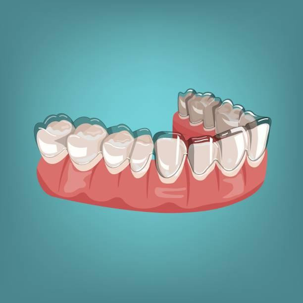 How can I straighten my teeth the right way? - JustPaste.it